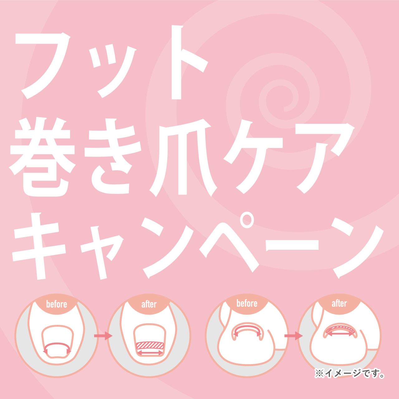 巻き爪ケアキャンペーン