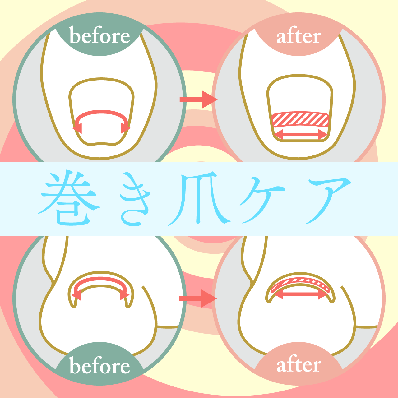 初めてのご利用の方限定!巻き爪ケア10%OFFキャンペーン